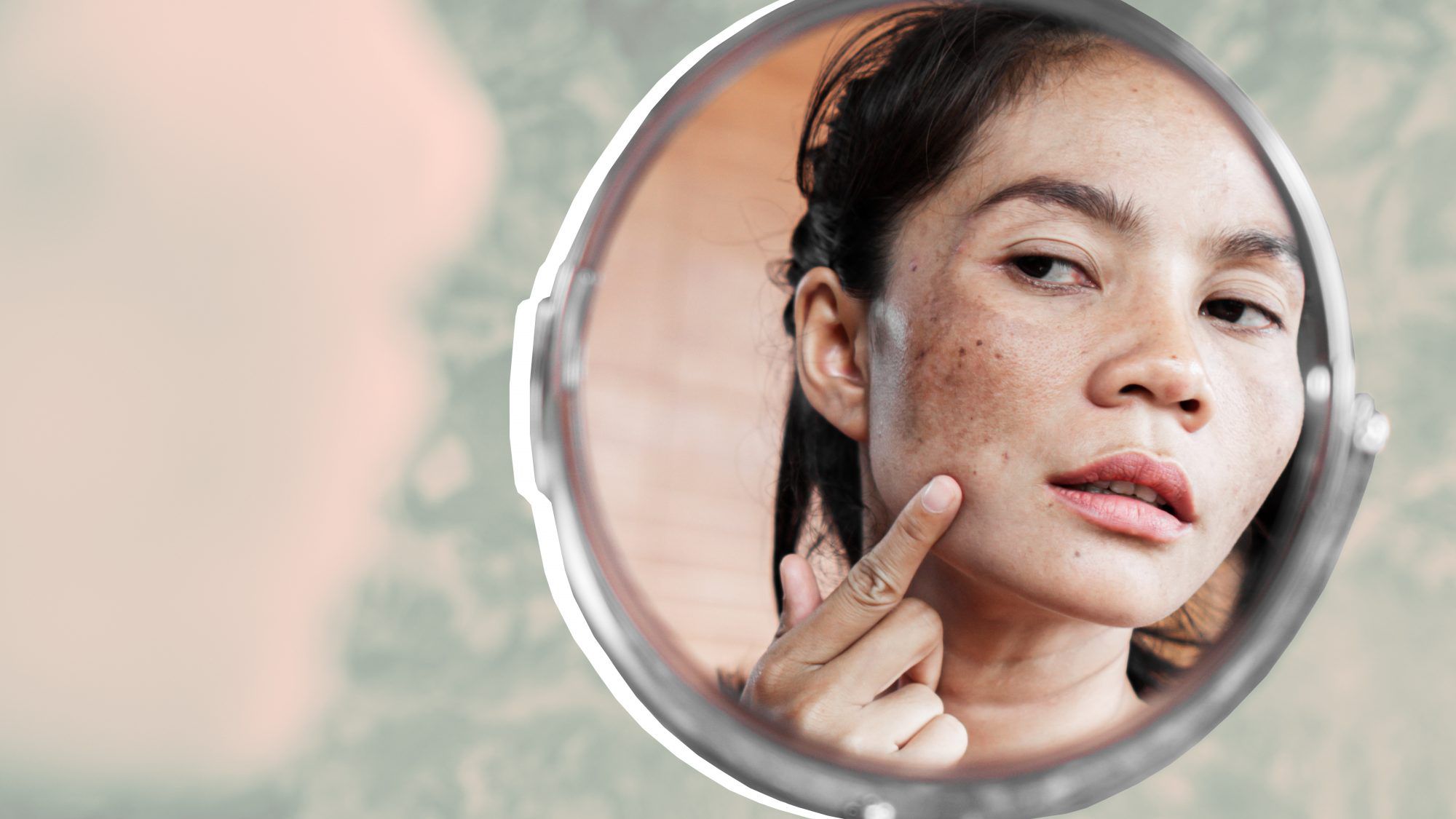 Pregnancy Melasma (Chloasma): Causes And Remedies